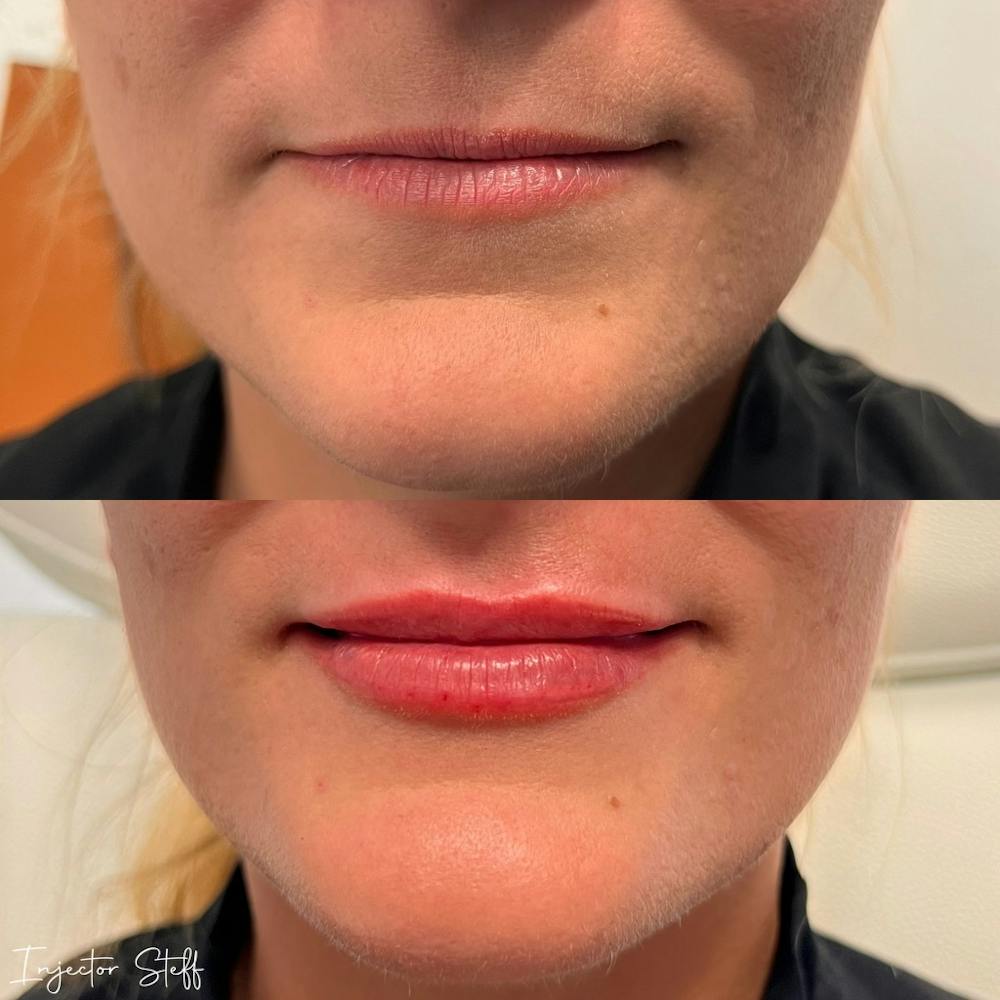 Lip Fillers Before & After Gallery - Patient 223887 - Image 1