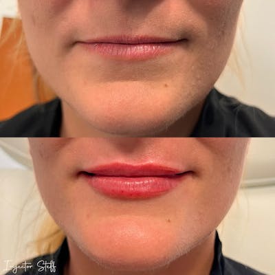 Lip Fillers Before & After Gallery - Patient 223887 - Image 1