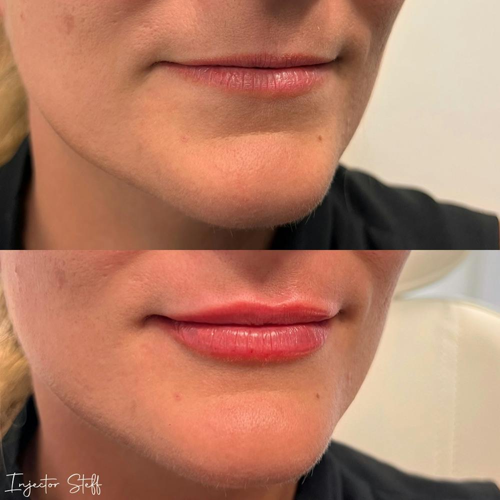 Lip Fillers Before & After Gallery - Patient 223887 - Image 2