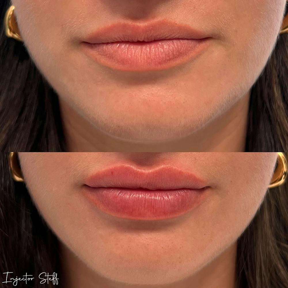 Lip Fillers Before & After Gallery - Patient 257010 - Image 1