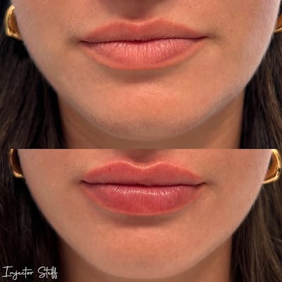 Lip Fillers Before & After Gallery - Patient 257010 - Image 1