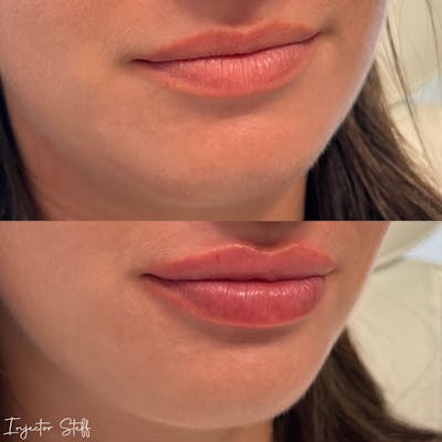 Lip Fillers Before & After Gallery - Patient 257010 - Image 2