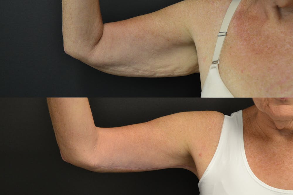 Brachioplasty Before & After Gallery - Patient 414279 - Image 1