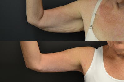 Brachioplasty Before & After Gallery - Patient 414279 - Image 1