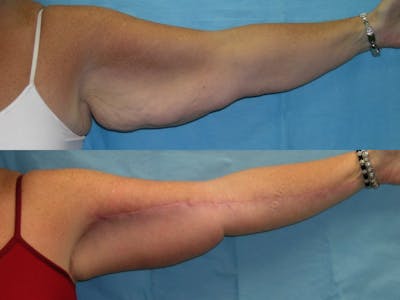 Brachioplasty Before & After Gallery - Patient 124268 - Image 1