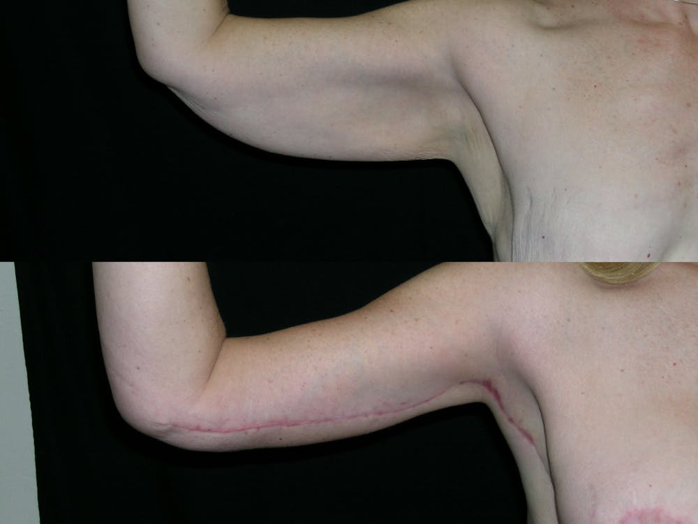 Brachioplasty Before & After Gallery - Patient 303424 - Image 1