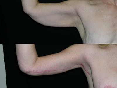 Brachioplasty Before & After Gallery - Patient 303424 - Image 1