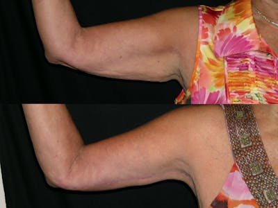 Brachioplasty Before & After Gallery - Patient 283720 - Image 1
