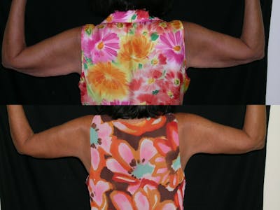 Brachioplasty Before & After Gallery - Patient 141075 - Image 1