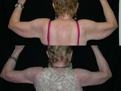 Brachioplasty Before & After Gallery - Patient 321295 - Image 1