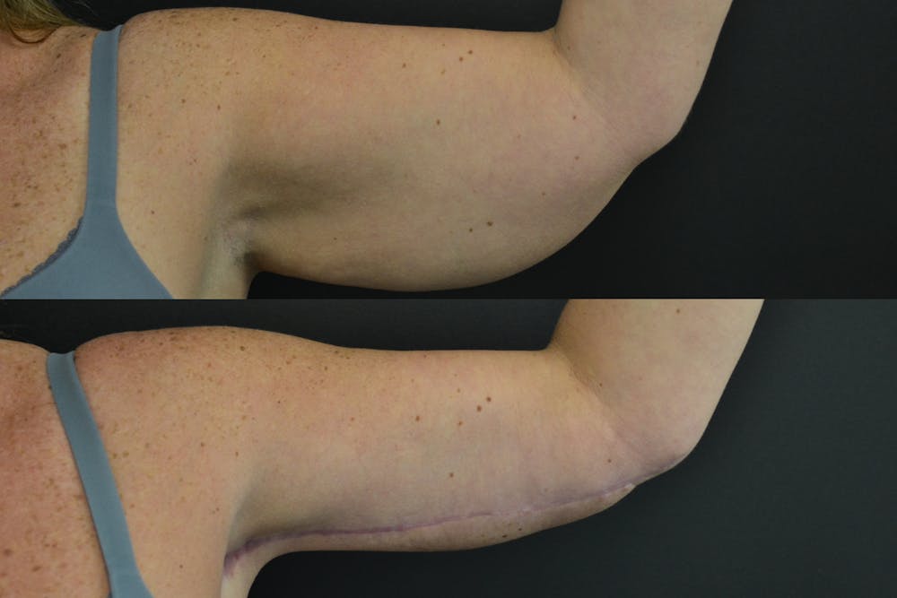 Brachioplasty Before & After Gallery - Patient 407052 - Image 2