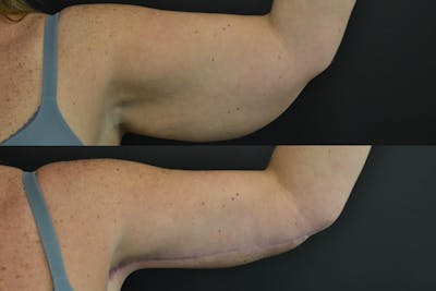 Brachioplasty Before & After Gallery - Patient 407052 - Image 2