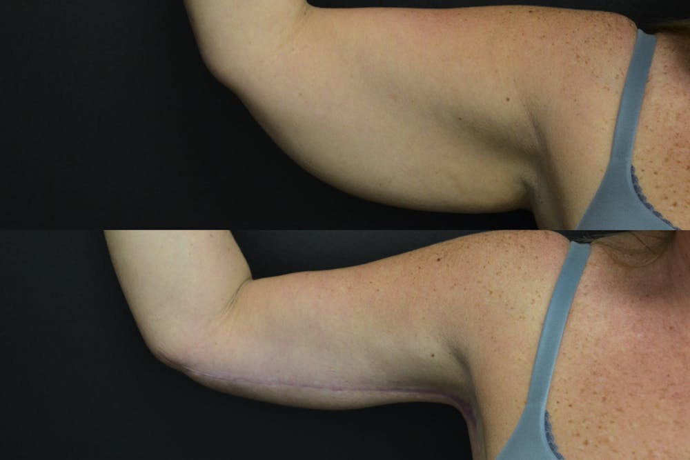 Brachioplasty Before & After Gallery - Patient 407052 - Image 1