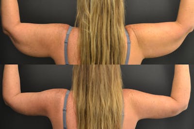 Brachioplasty Before & After Gallery - Patient 307004 - Image 1