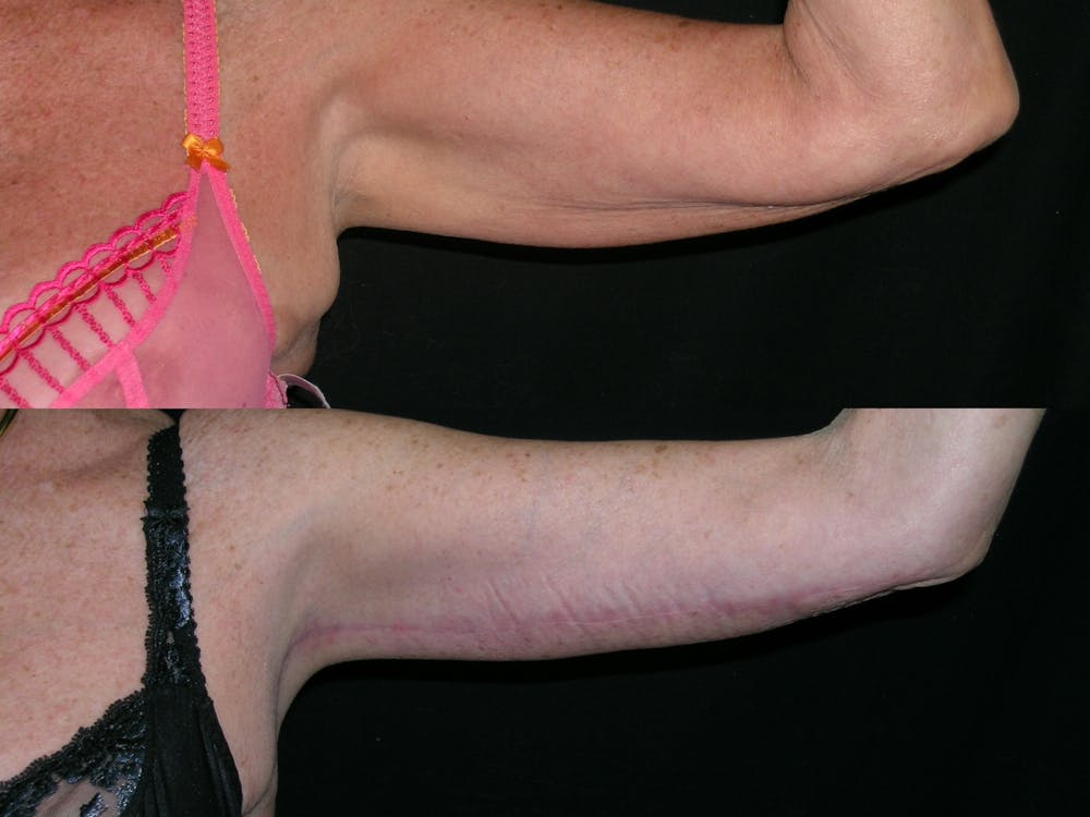Brachioplasty Before & After Gallery - Patient 963625 - Image 2