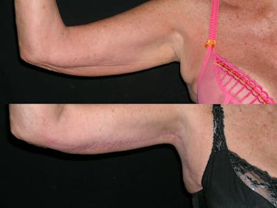 Brachioplasty Before & After Gallery - Patient 963625 - Image 1