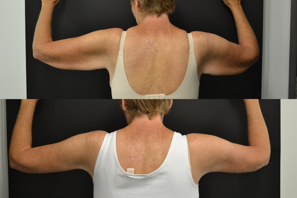 Brachioplasty Before & After Gallery - Patient 352782 - Image 2