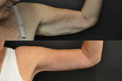 Brachioplasty Before & After Gallery - Patient 352782 - Image 1