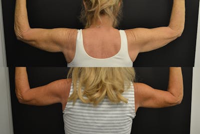 Brachioplasty Before & After Gallery - Patient 172077 - Image 1