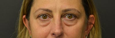 Blepharoplasty Before & After Gallery - Patient 352302 - Image 2