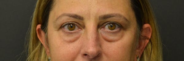 Blepharoplasty Before & After Gallery - Patient 352302 - Image 2