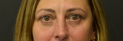 Blepharoplasty Before & After Gallery - Patient 352302 - Image 1