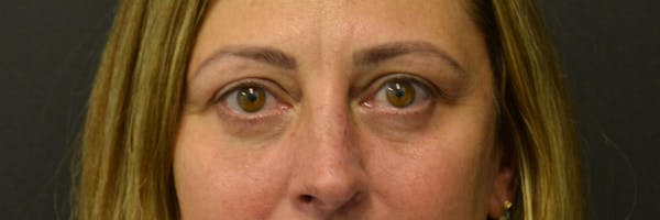 Blepharoplasty Before & After Gallery - Patient 352302 - Image 1