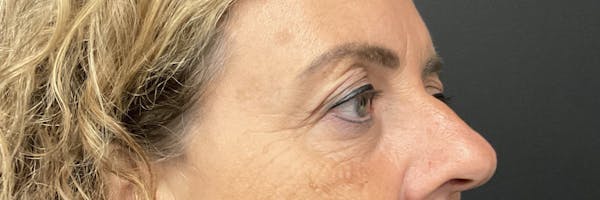 Blepharoplasty Before & After Gallery - Patient 352302 - Image 3