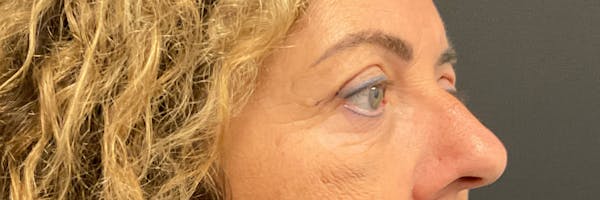 Blepharoplasty Before & After Gallery - Patient 352302 - Image 4
