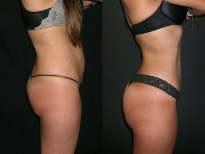 Brazilian Butt Lift Before & After Gallery - Patient 517917 - Image 1