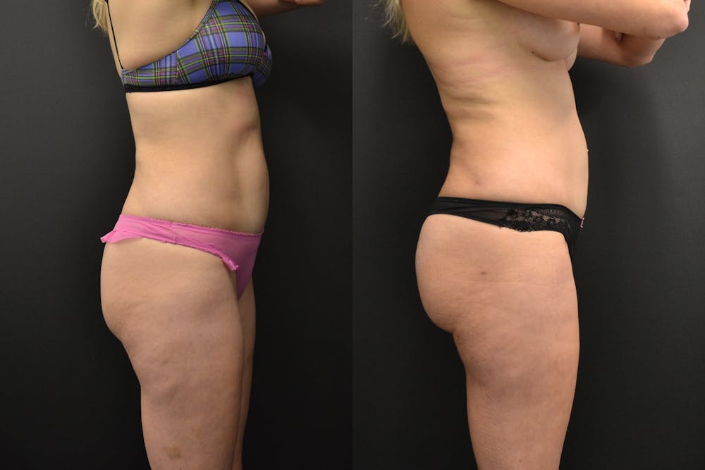 Brazilian Butt Lift Before & After Gallery - Patient 414913 - Image 1