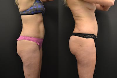Brazilian Butt Lift Before & After Gallery - Patient 414913 - Image 1