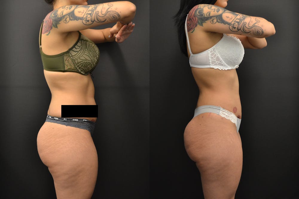 Brazilian Butt Lift Before & After Gallery - Patient 252209 - Image 1