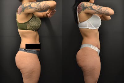Brazilian Butt Lift Before & After Gallery - Patient 252209 - Image 1