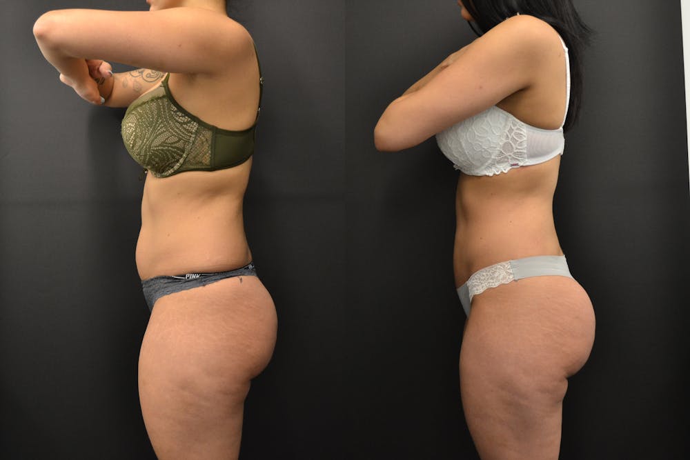 Brazilian Butt Lift Before & After Gallery - Patient 252209 - Image 2