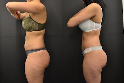 Brazilian Butt Lift Before & After Gallery - Patient 252209 - Image 2
