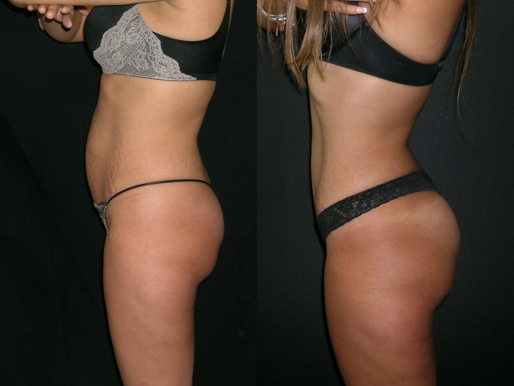 Brazilian Butt Lift Before & After Gallery - Patient 517917 - Image 2
