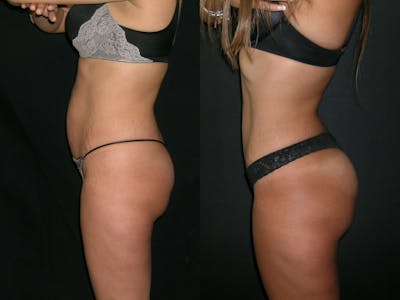 Brazilian Butt Lift Before & After Gallery - Patient 517917 - Image 2