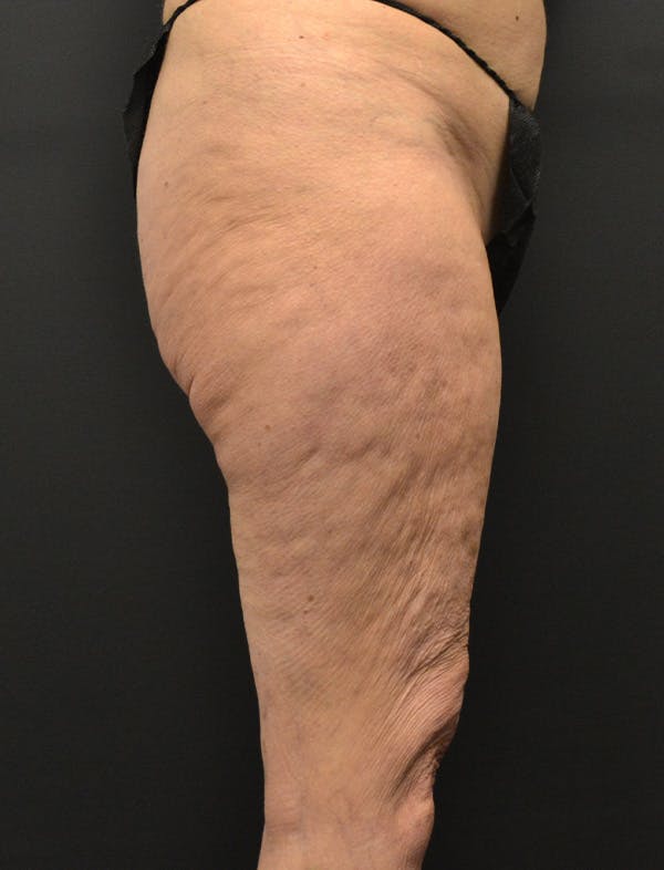 Liposuction & SmartLipo Before & After Gallery - Patient 200645 - Image 3