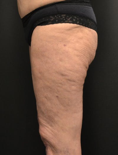 Liposuction & SmartLipo Before & After Gallery - Patient 200645 - Image 6