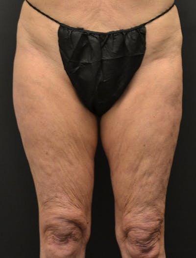 Liposuction & SmartLipo Before & After Gallery - Patient 200645 - Image 1