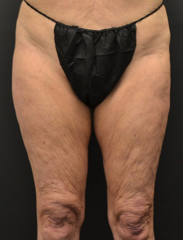 Liposuction & SmartLipo Before & After Gallery - Patient 200645 - Image 1