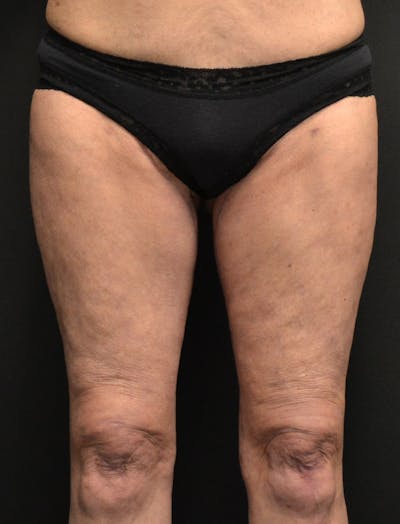 Liposuction & SmartLipo Before & After Gallery - Patient 200645 - Image 2