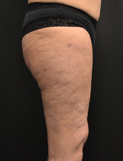 Liposuction & SmartLipo Before & After Gallery - Patient 200645 - Image 4