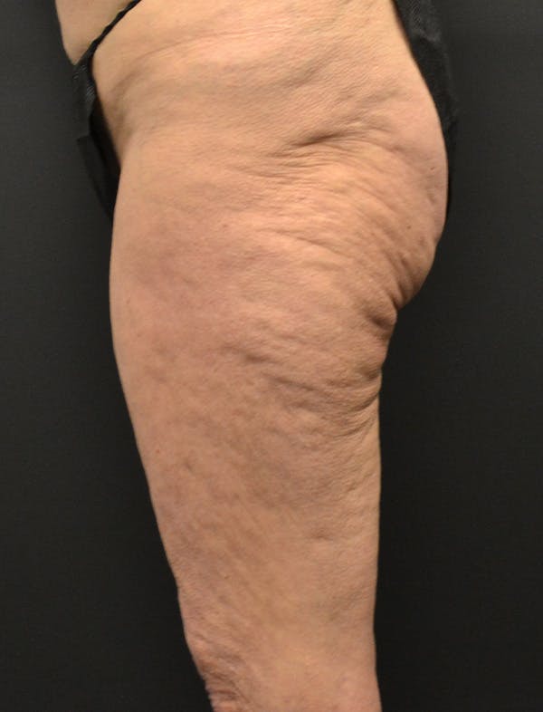 Liposuction & SmartLipo Before & After Gallery - Patient 200645 - Image 5
