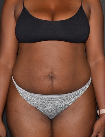 Liposuction & SmartLipo Before & After Gallery - Patient 289711 - Image 1