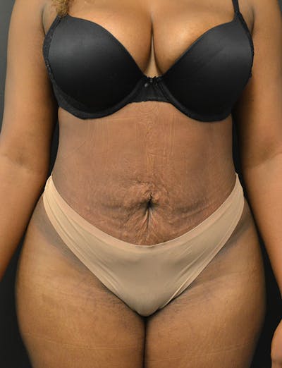 Liposuction & SmartLipo Before & After Gallery - Patient 289711 - Image 2