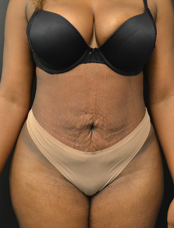 Liposuction & SmartLipo Before & After Gallery - Patient 289711 - Image 2