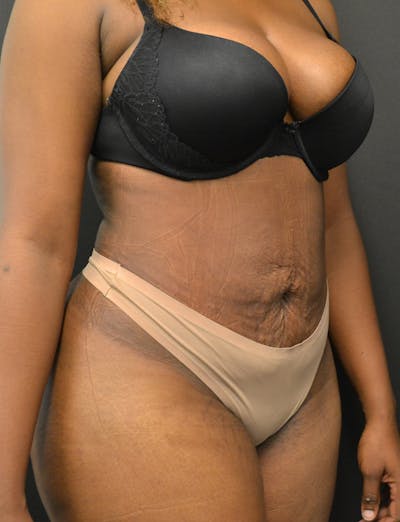 Liposuction & SmartLipo Before & After Gallery - Patient 289711 - Image 4