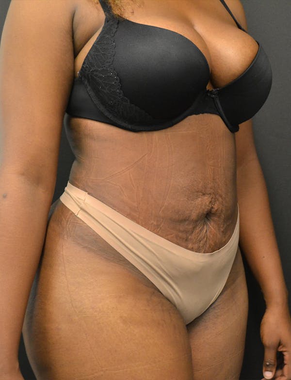 Liposuction & SmartLipo Before & After Gallery - Patient 289711 - Image 4